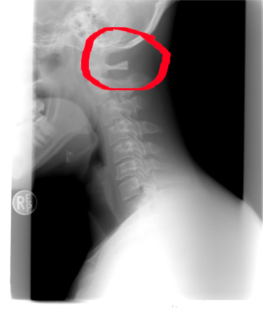 cervical spine